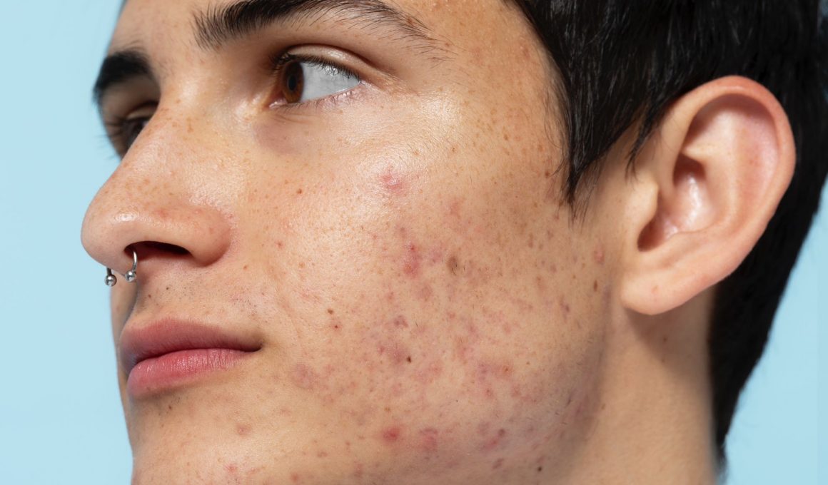 Cómo eliminar el acné