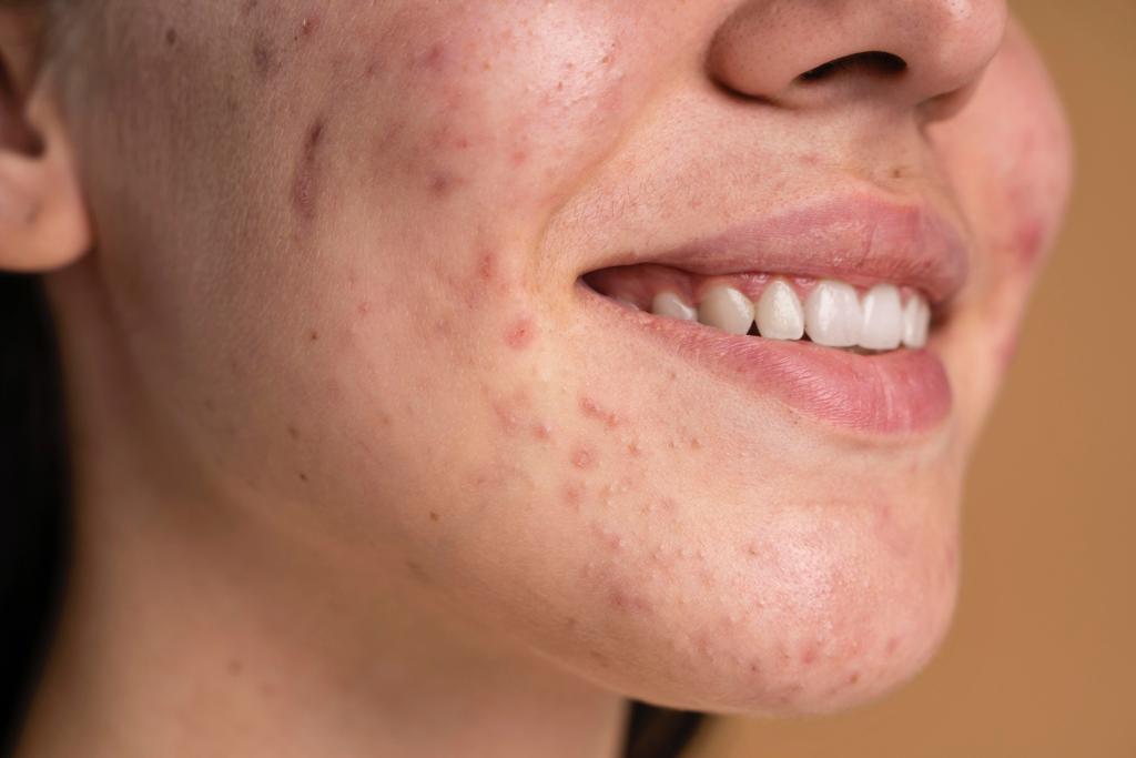 How to fight acne pimples