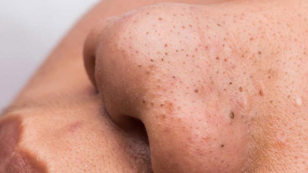 Punti neri sul naso: i consigli per una pelle radiosa