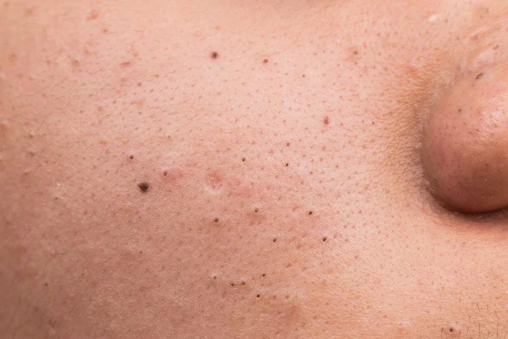 How to eliminate blackheads