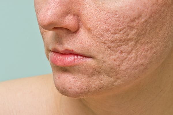 How to eliminate acne scars