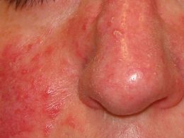 Rosacea causas y remedios