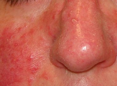 Rosacea causas y remedios