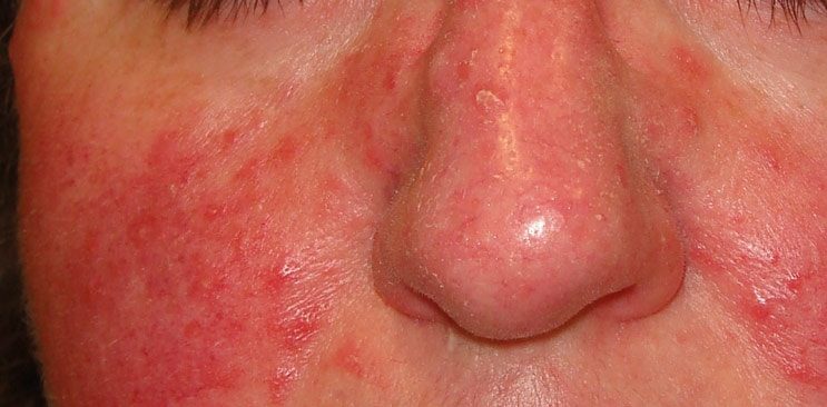 Rosacea causas y remedios