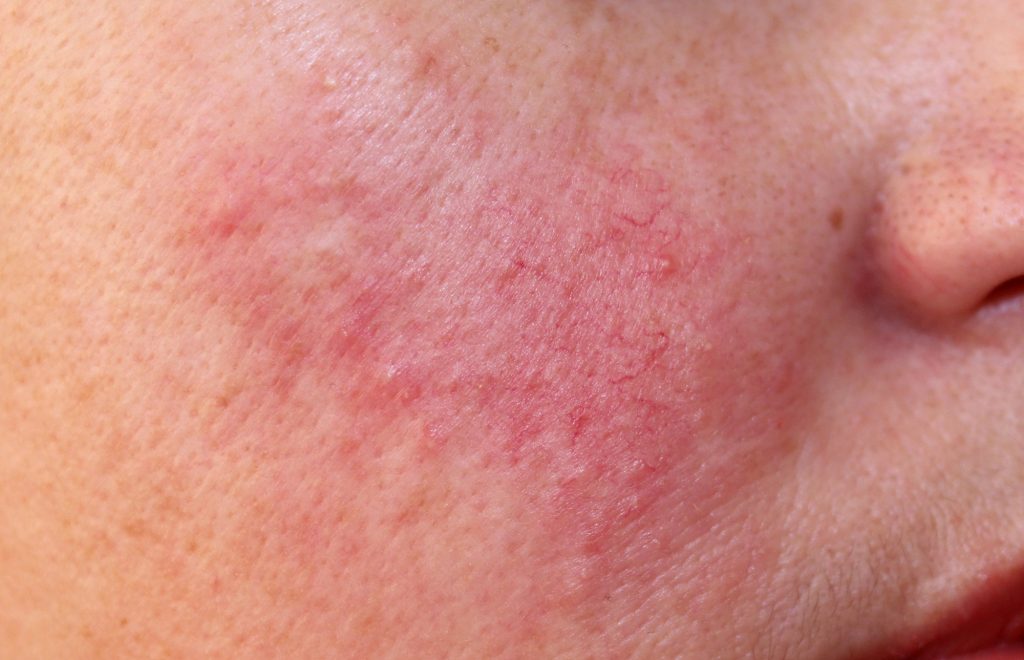 Rosacea remedies