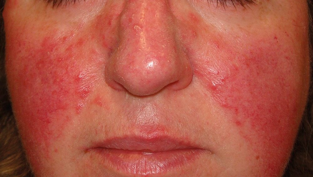 Rosacea what to do