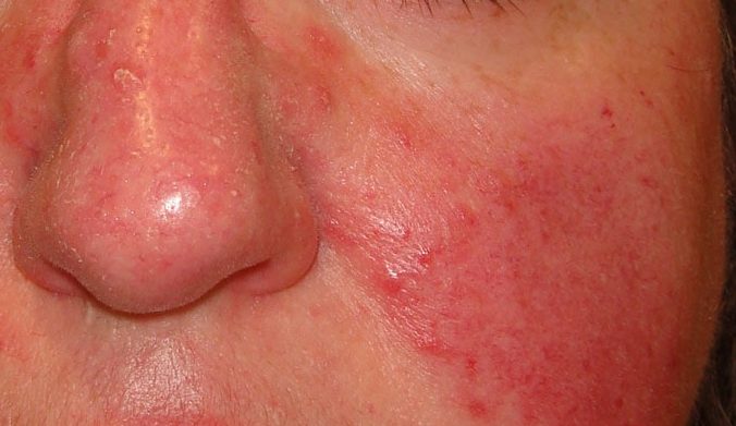 Rosacea que hacer